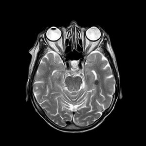 the different types of tinnitus